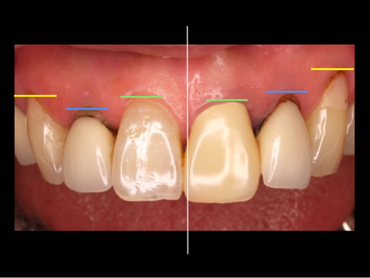 ティッシュマネージメントを配慮した前歯部インプラント症例07