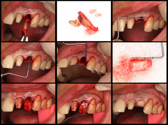ティッシュマネージメントを配慮した前歯部インプラント症例09