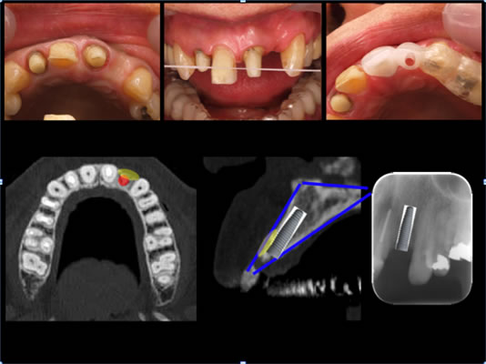 ティッシュマネージメントを配慮した前歯部インプラント症例10