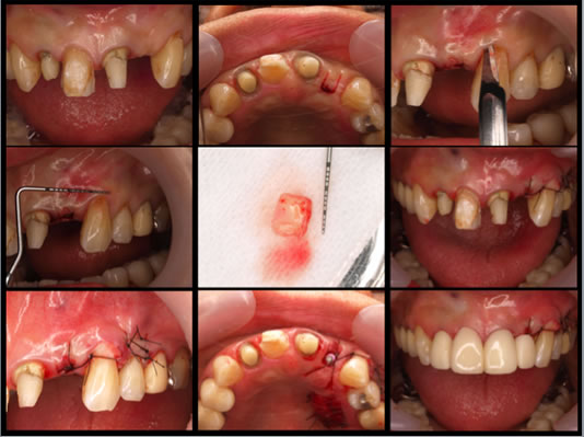 ティッシュマネージメントを配慮した前歯部インプラント症例13