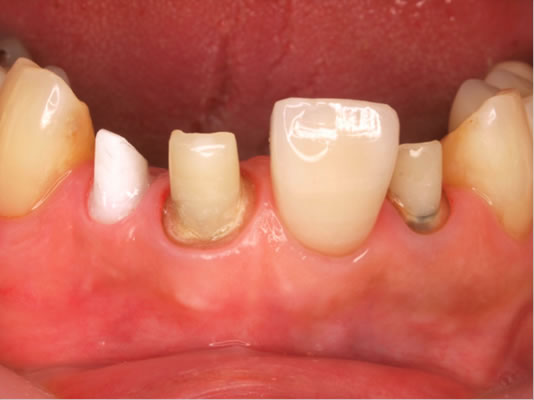 ティッシュマネージメントを配慮した前歯部インプラント症例19
