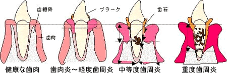 歯周病図-1