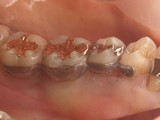 歯周病（歯槽膿漏）治療1