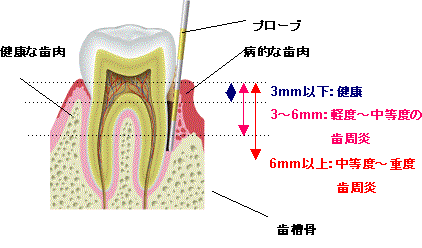 歯周病図-2