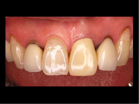 ティッシュマネージメントを配慮した前歯部インプラント症例02