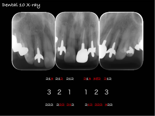 ティッシュマネージメントを配慮した前歯部インプラント症例03