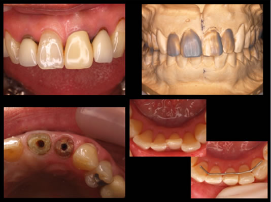 ティッシュマネージメントを配慮した前歯部インプラント症例04
