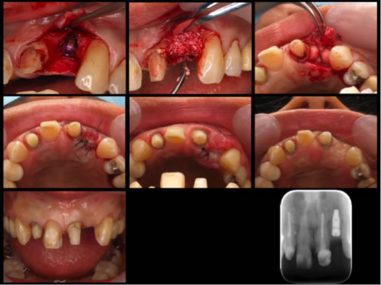 ティッシュマネージメントを配慮した前歯部インプラント症例11
