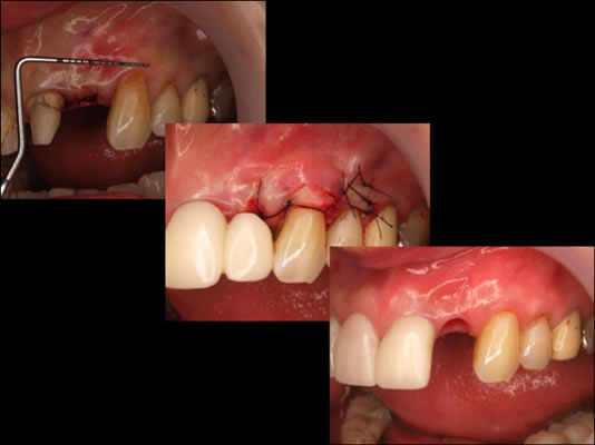 ティッシュマネージメントを配慮した前歯部インプラント症例14