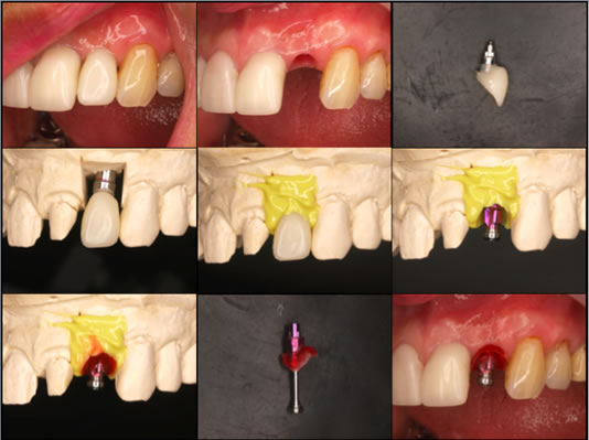 ティッシュマネージメントを配慮した前歯部インプラント症例16