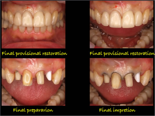 ティッシュマネージメントを配慮した前歯部インプラント症例18
