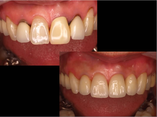 ティッシュマネージメントを配慮した前歯部インプラント症例20