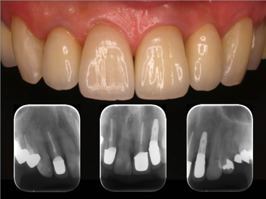 ティッシュマネージメントを配慮した前歯部インプラント症例21